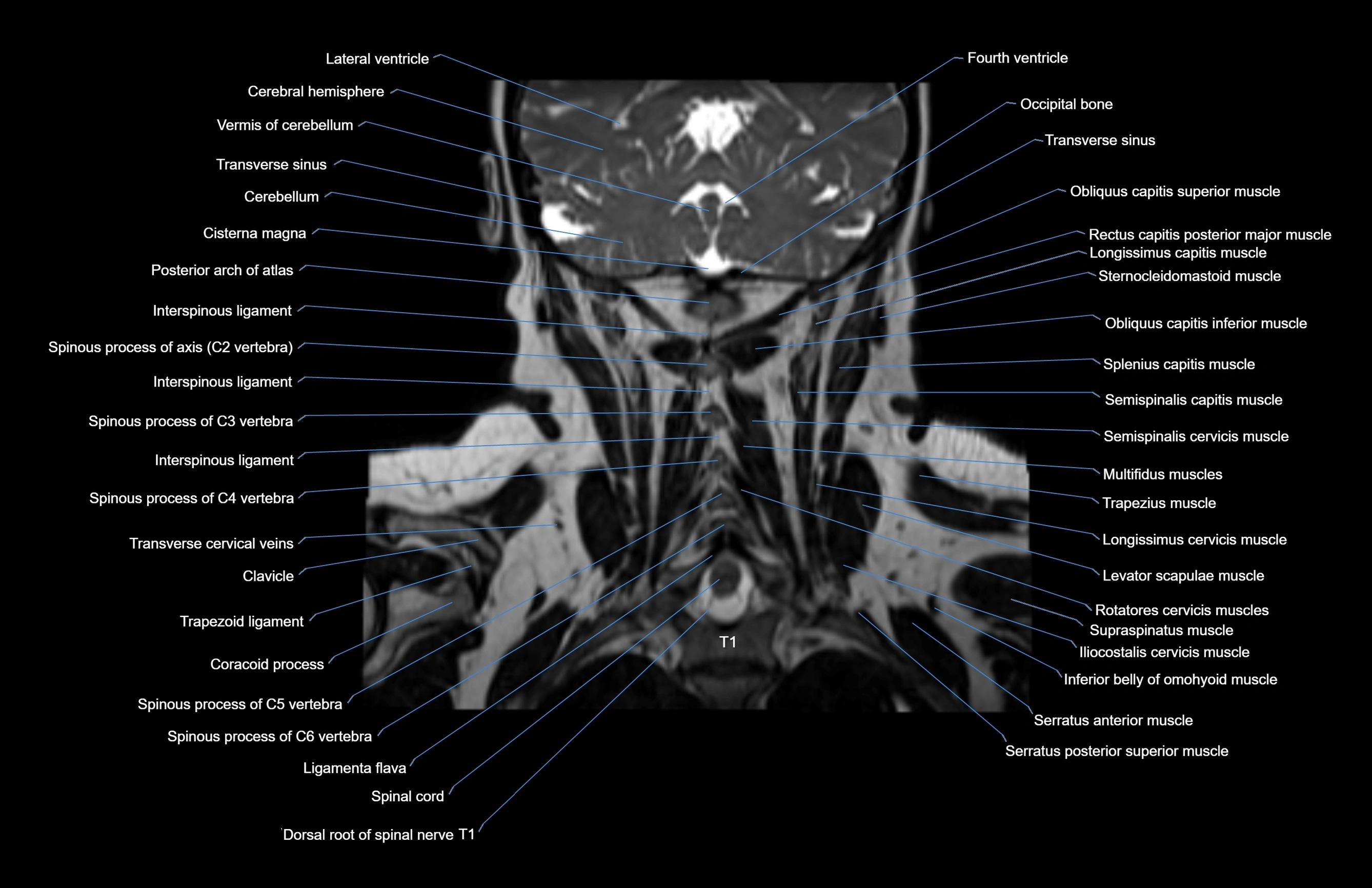 Neck coronal cross sectional MRI anatomy 3T MRI  image-img-00001-00017.webp